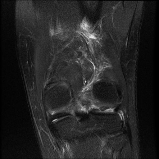 File:Bucket-handle meniscus tear (Radiopaedia 65700-74809 Coronal T2 fat sat 6).jpg