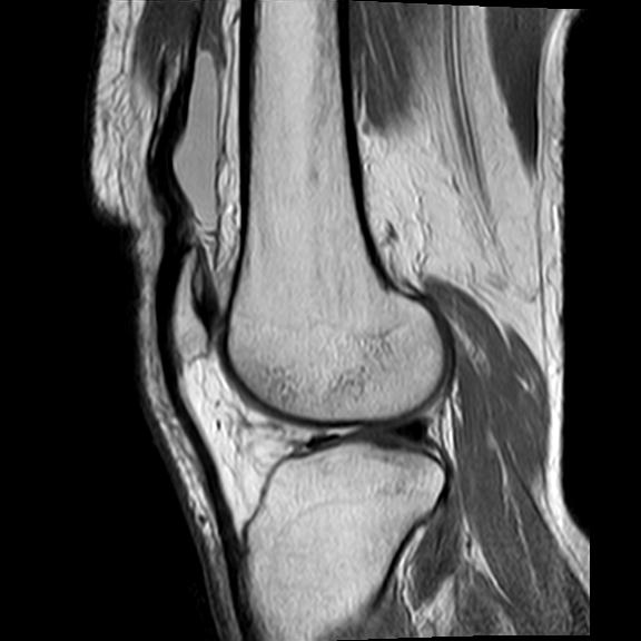 File:Bucket handle tear - medial meniscus (Radiopaedia 29250-29664 Sagittal PD 7).jpg