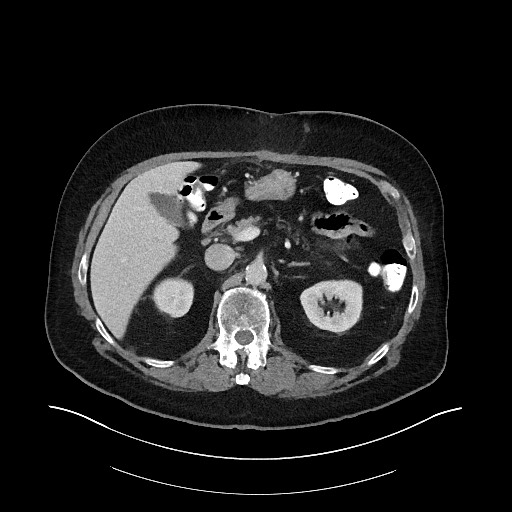 Buried bumper syndrome - gastrostomy tube (Radiopaedia 63843-72575 A 21).jpg