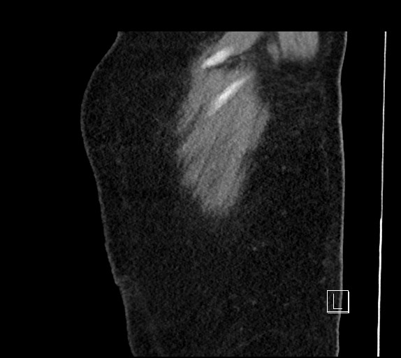 Buried bumper syndrome - gastrostomy tube (Radiopaedia 63843-72577 Sagittal Inject 117).jpg