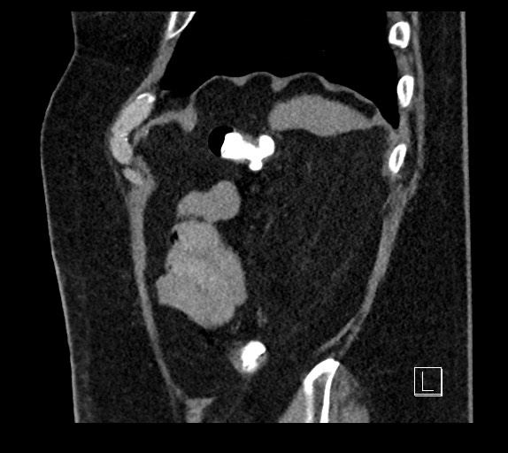 Buried bumper syndrome - gastrostomy tube (Radiopaedia 63843-72577 Sagittal Inject 18).jpg