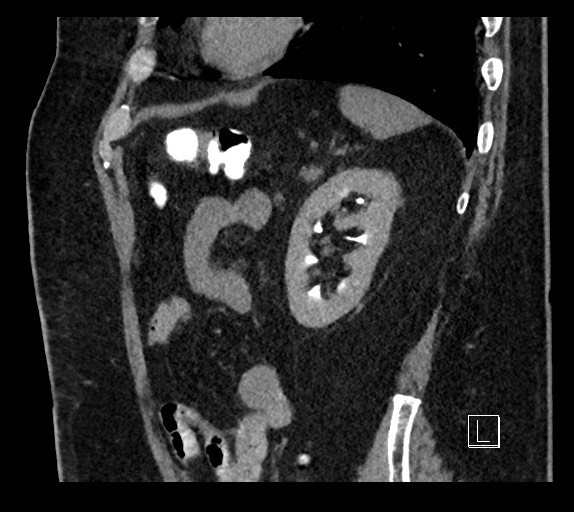Buried bumper syndrome - gastrostomy tube (Radiopaedia 63843-72577 Sagittal Inject 29).jpg