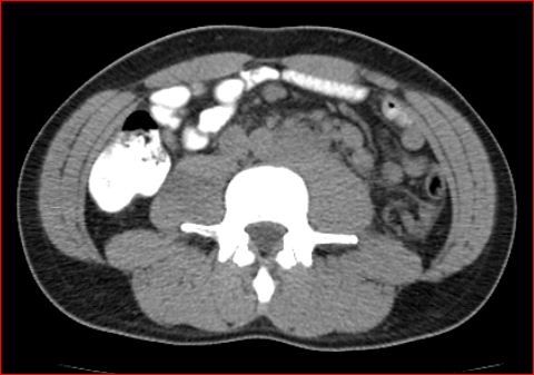 File:Burned-out testicular choriocarcinoma (Radiopaedia 32822-34040 Axial non-contrast 15).jpg