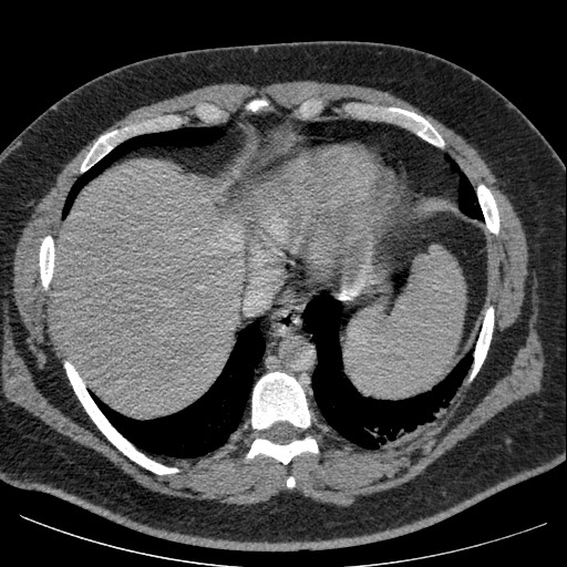 Burned-out testicular seminoma - retroperitoneal nodal metastases (Radiopaedia 62872-71245 A 9).jpg