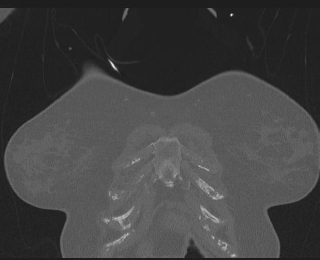 Burst fracture - thoracic spine (Radiopaedia 30238-30865 Coronal bone window 20).jpg