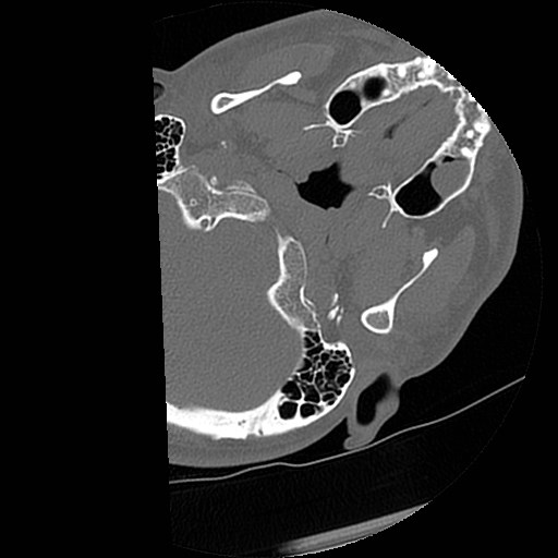 C1-C2 "subluxation" - normal cervical anatomy at maximum head rotation (Radiopaedia 42483-45607 Axial non-contrast 67).jpg