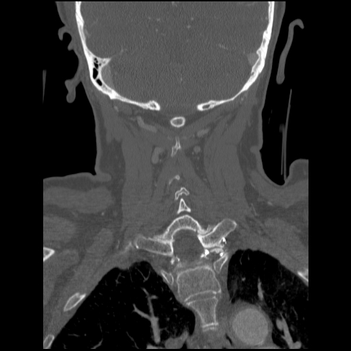 File:C1 anterior arch (plough) fracture - type 1 (Radiopaedia 76181-87720 Coronal bone window 30).jpg