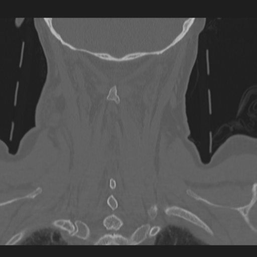 C2 fracture (Radiopaedia 34091-35341 Coronal bone window 45).png