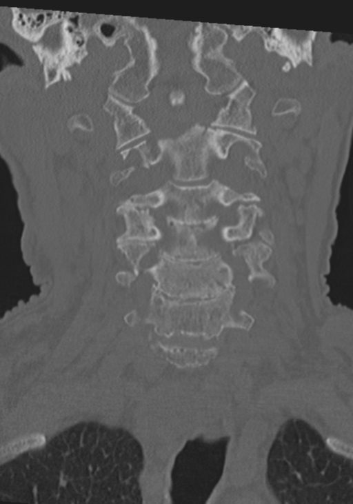 C2 fracture with vertebral artery dissection (Radiopaedia 37378-39199 Coronal bone window 16).png