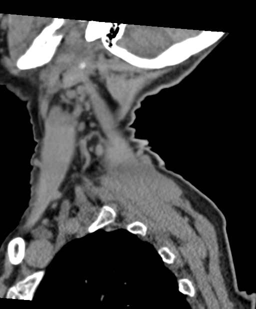 C2 fracture with vertebral artery dissection (Radiopaedia 37378-39199 D 12).png