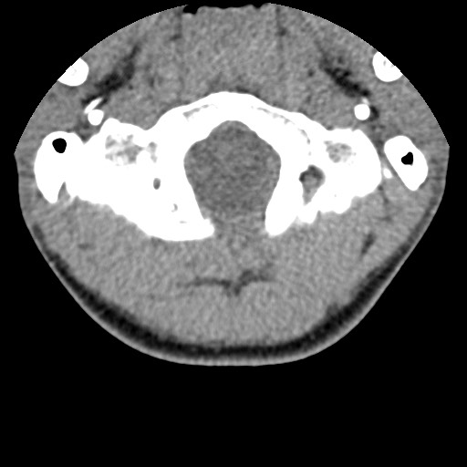 File:C5 facet fracture (Radiopaedia 58374-65499 Axial non-contrast 7).jpg
