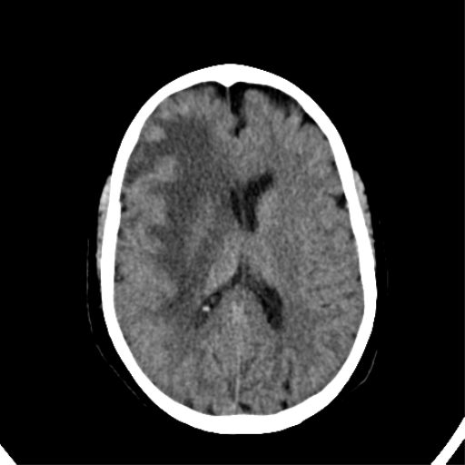 File:CNS Lymphoma (Radiopaedia 44198-47794 Axial non-contrast 22).png