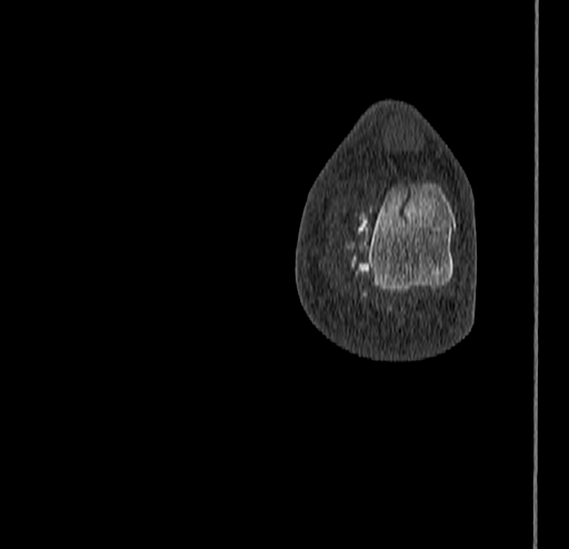Calcaneal fracture - Sanders type 4 (Radiopaedia 90179-107370 Coronal bone window 86).jpg