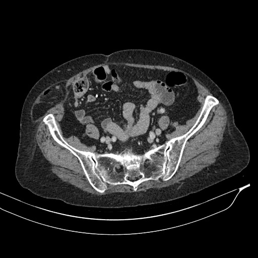 Calcified adrenal glands and Spigelian hernia (Radiopaedia 49741-54988 A 176).jpg