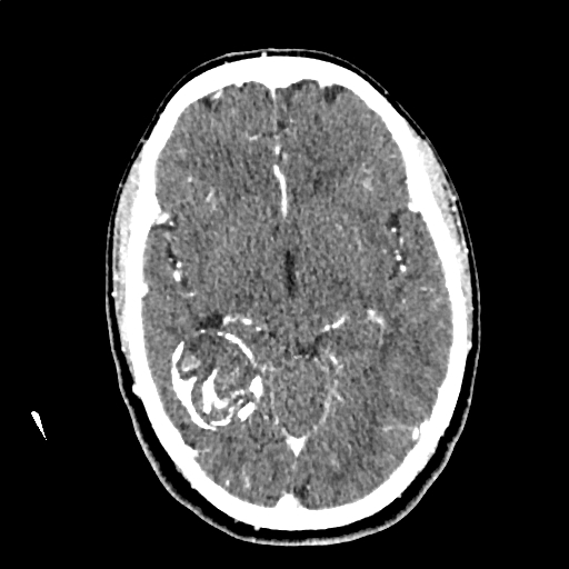 File:Calcified cerebral hydatid cyst (Radiopaedia 65603-74717 Axial with contrast 32).jpg