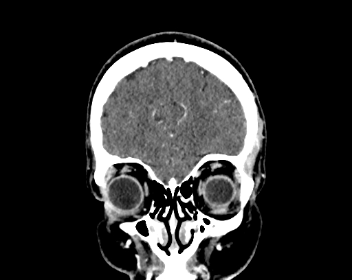 File:Calcified cerebral hydatid cyst (Radiopaedia 65603-74717 C 10).jpg