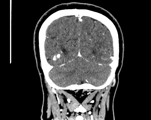 Calcified cerebral hydatid cyst (Radiopaedia 65603-74717 C 61).jpg