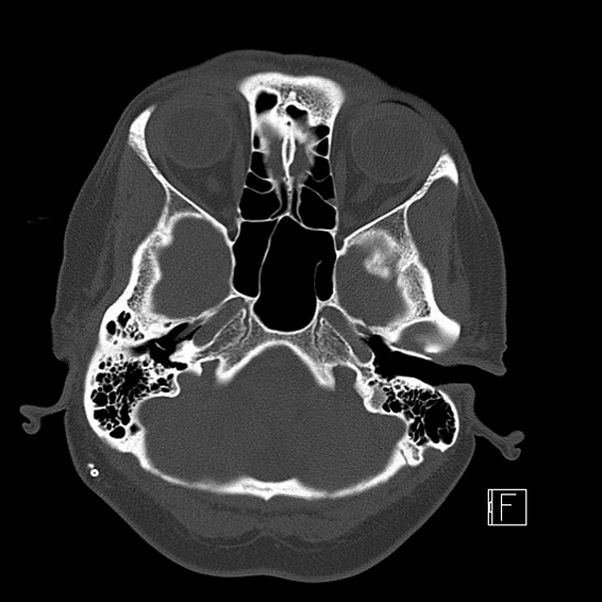 Calcified chronic subdural hematoma (Radiopaedia 77374-89492 Axial bone window 23).jpg