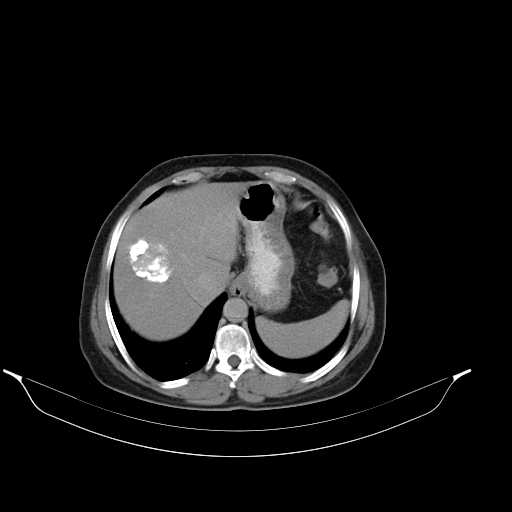 File:Calcified hydatid cyst of the liver (Radiopaedia 21212-21112 Axial C+ delayed 11).jpg
