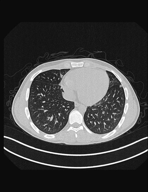 Calcifying pulmonary metastases (Radiopaedia 33359-34396 Axial lung window 45).jpg