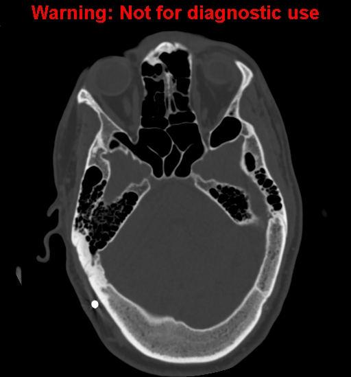 Calvarial thickening from chronic shunting (Radiopaedia 60079-67637 Axial bone window 56).jpg