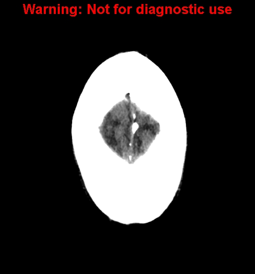 File:Calvarial thickening from chronic shunting (Radiopaedia 60079-67637 Axial non-contrast 28).jpg