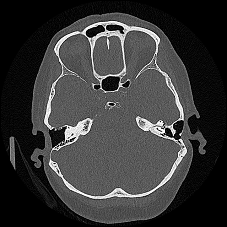 Canal up mastoidectomy (Radiopaedia 78108-90638 Axial bone window 95).jpg