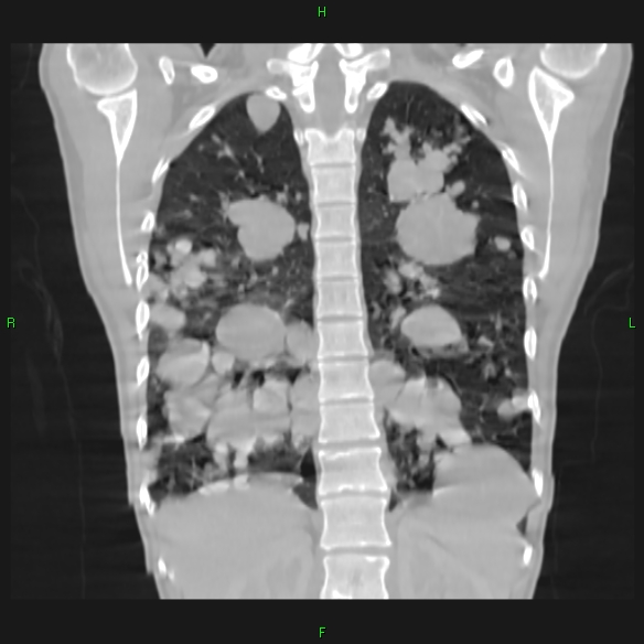 File:Cannon ball metastases - synovial sarcoma (Radiopaedia 26135-26271 Coronal lung window 15).jpg