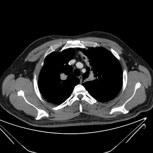 File:Cannonball pulmonary metastases (Radiopaedia 67684-77101 D 72).jpg