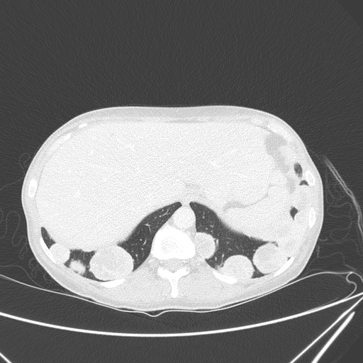 Canonball lung metastasis (Radiopaedia 77634-89837 Axial lung window 161).jpg