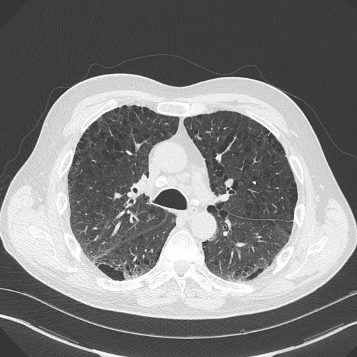 Caplan syndrome (Radiopaedia 56667-63530 Axial lung window 82).jpg