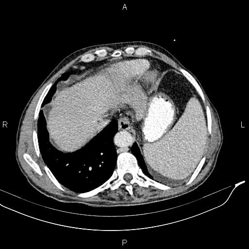 Caput medusae sign - portal hypertension (Radiopaedia 64007-72759 A 6).jpg
