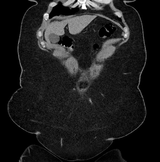 Carcinoid tumor - terminal ileum (Radiopaedia 60931-68740 Coronal non-contrast 11).jpg