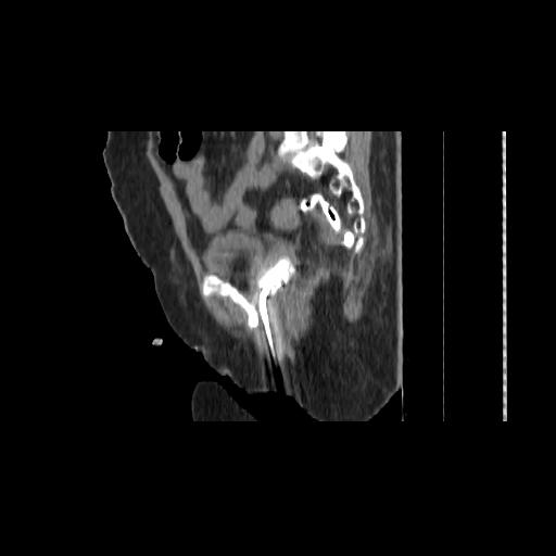 File:Carcinoma cervix- brachytherapy applicator (Radiopaedia 33135-34173 D 112).jpg