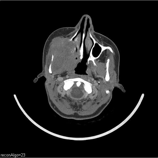 Carcinoma of the maxillary antrum (Radiopaedia 53805-59888 Axial C+ delayed 50).jpg