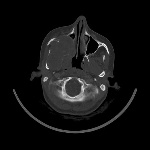 Carcinoma of the maxillary antrum (Radiopaedia 53805-59888 Axial bone window 53).jpg