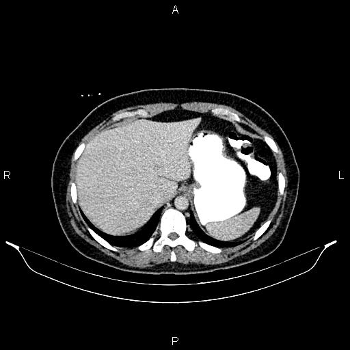 Carcinoma of uterine cervix (Radiopaedia 85861-101700 A 32).jpg