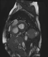 Cardiac amyloidosis (Radiopaedia 51404-57150 Sagittal CINE SSFP 241).jpg