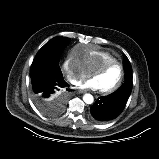 File:Cardiac lymphoma (Radiopaedia 38690-40836 Axial C+ CTPA 14).jpg