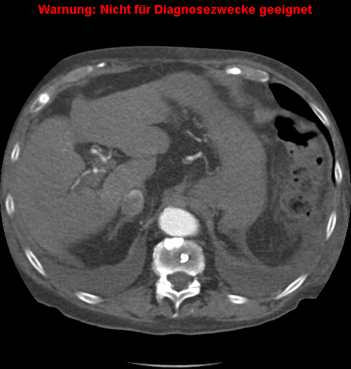 File:Cardiac perforation following transcatheter aortic valve implantation (Radiopaedia 23714-23863 A 21).png