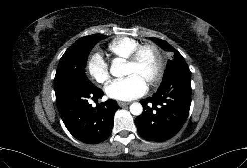 Cardiac sarcoidosis (Radiopaedia 74548-85534 A 51).jpg