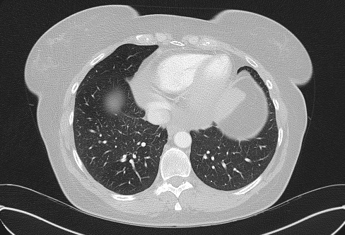 Cardiac sarcoidosis (Radiopaedia 74548-85534 Axial lung window 67).jpg