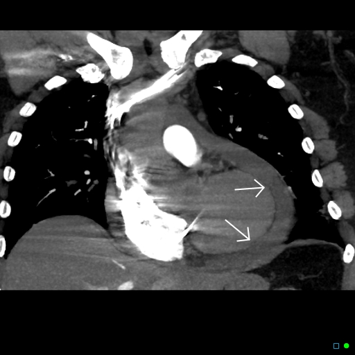 File:Cardiac tamponade (Radiopaedia 20909-20841 C+ arterial phase 1).jpg
