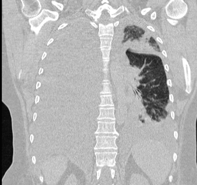 Cardiogenic pulmonary edema (Radiopaedia 29213-29609 Coronal lung window 48).jpg