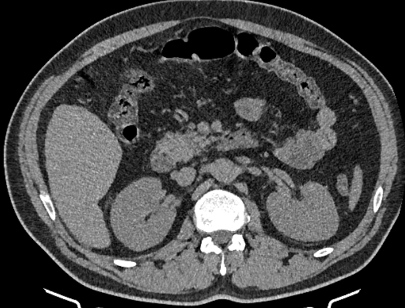 Cardiogenic pulmonary edema (Radiopaedia 68180-77678 Axial non-contrast 75).jpg