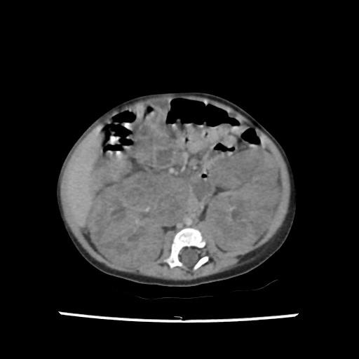 Caroli disease with autosomal recessive polycystic kidney disease (ARPKD) (Radiopaedia 89651-106703 B 124).jpg