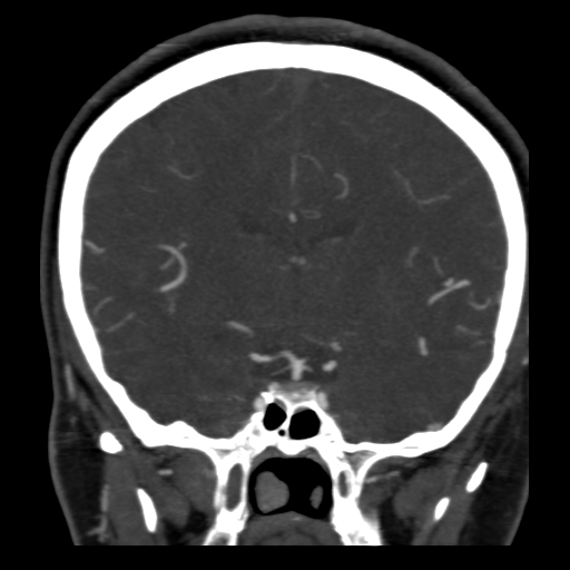 File:Carotico ophthalmic aneurysm (Radiopaedia 42916-46148 B 8).png