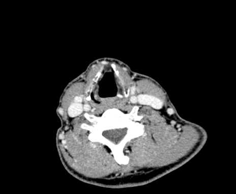 Carotid body tumor (Radiopaedia 61750-69757 Axial Post contrast 76).jpg