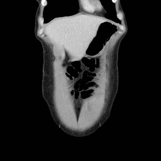 Castleman disease with fibrous pseudotumor in the abdomen (Radiopaedia 77296-89373 B 16).jpg