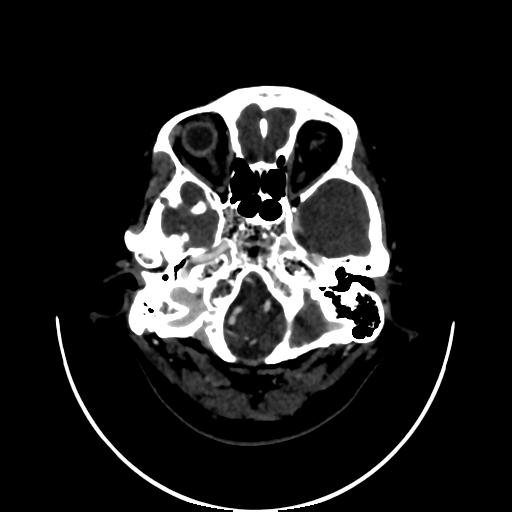 Cavernoma with developmental venous anomaly (Radiopaedia 22470-22506 C 14).jpg
